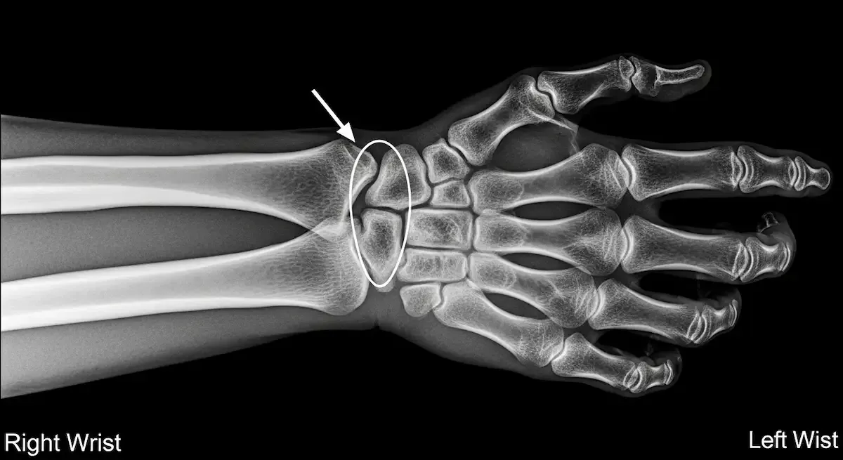 Síndrome do Canal de Guyon: o que é e como tratar