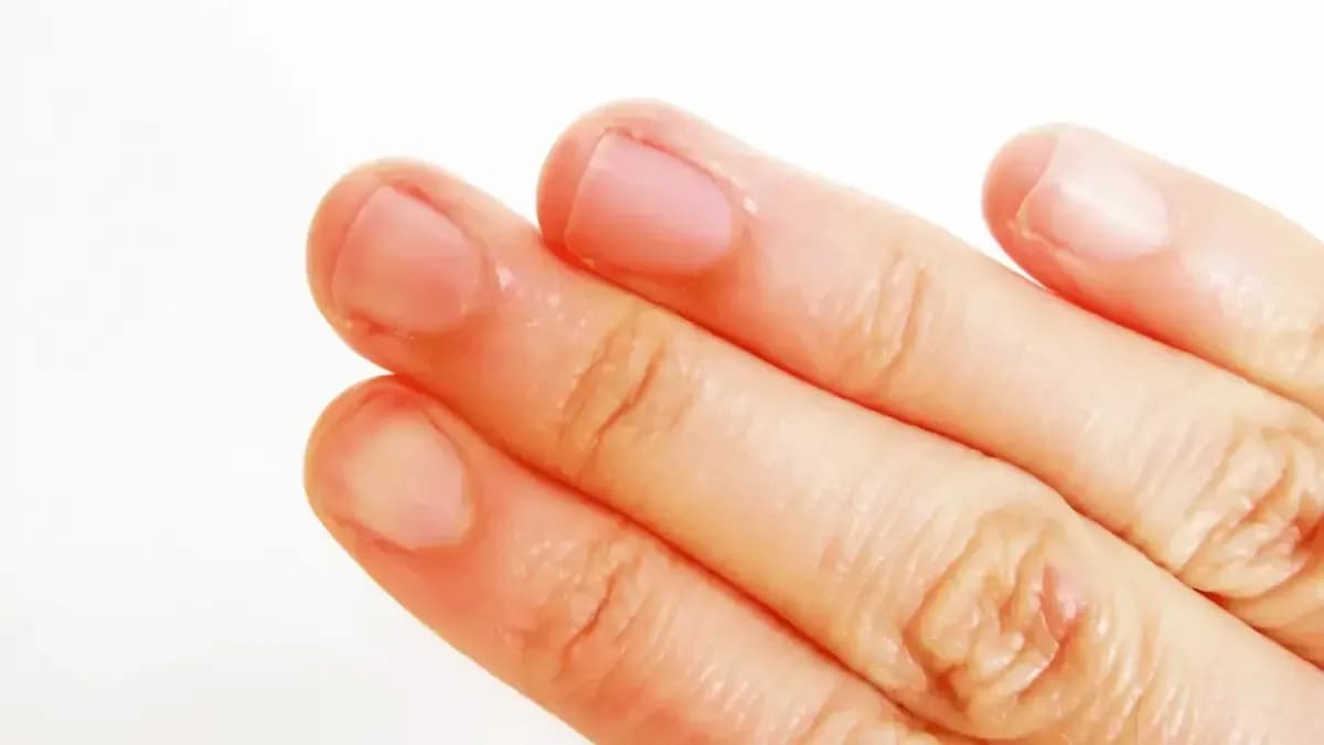 Sensação de queimação na ponta dos dedos das mãos: o que é