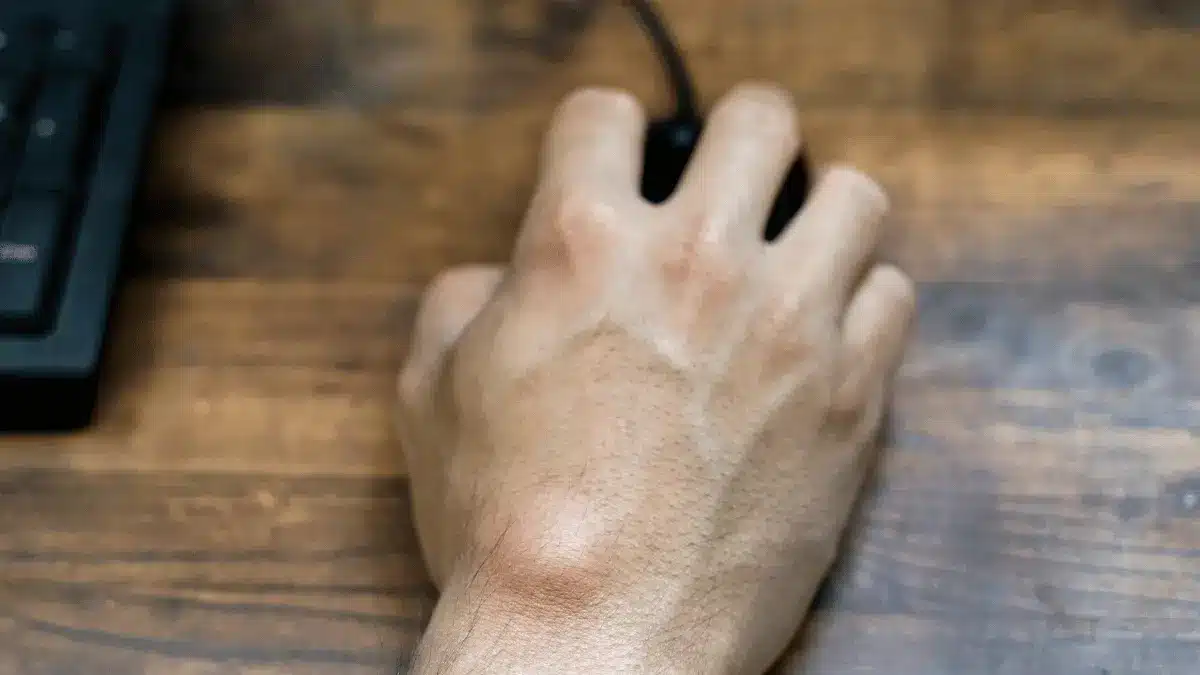 Bossa carpal
